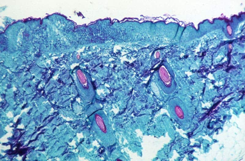 Monkeypox Gay Cases Rise; Europe Hits 100 Total; Triggers Emergency Who Monkeypox Meeting; Symptoms Mild; Spain Connects Monkeypox Virus, Sauna 1 522716 origin 1