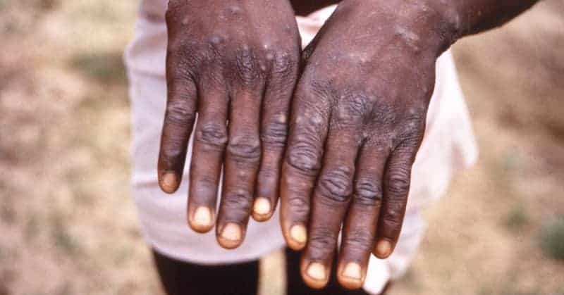 'Oh This Must Be Really Serious': Monkeypox Patient Shares His Story As Cases Continue To Grow 1 584313 origin 1