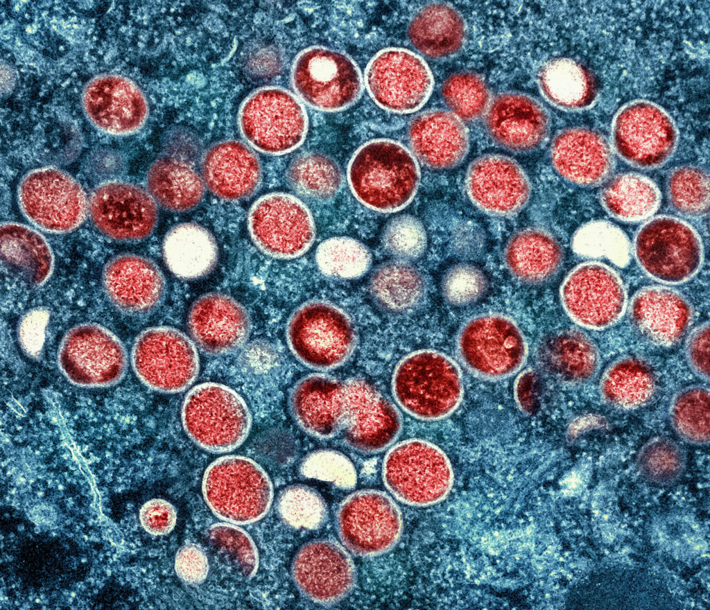 Govt'S Halting Response In Ramping Monkeypox Tests, Vaccines May Have Missed Chance To Contain Outbreak Over Last 30 Days. 1 monkeypox tests vaccines