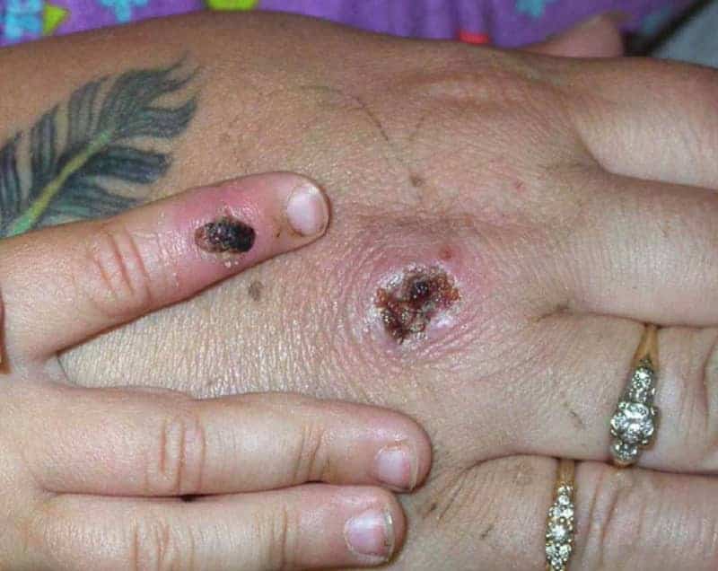 Monkeypox Cases In Nyc Double In A Week, Health Officials Say 1 593258 origin 1